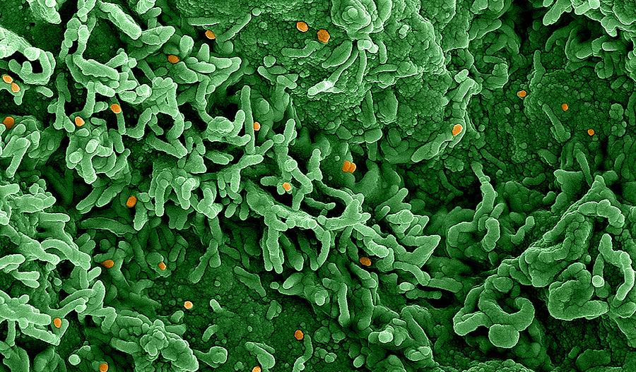 Imagen del virus de la viruela del simio (naranja) en células infectadas